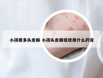 小孩很多头皮癣 小孩头皮癣症状用什么药膏