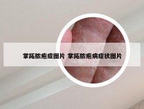 掌跖脓疱症图片 掌跖脓疱病症状图片