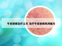 牛皮肤癣治疗土方 治疗牛皮肤癣民间偏方