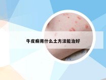 牛皮癣用什么土方法能治好