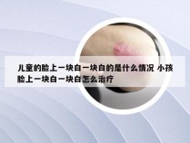 儿童的脸上一块白一块白的是什么情况 小孩脸上一块白一块白怎么治疗