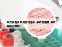 牛皮廨图片牛皮廨传染吗 牛皮廨图片 牛皮廨能治好吗