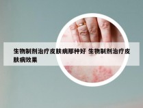 生物制剂治疗皮肤病那种好 生物制剂治疗皮肤病效果