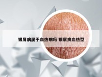 银屑病属于血热病吗 银屑病血热型