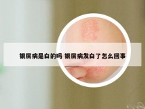 银屑病是白的吗 银屑病发白了怎么回事