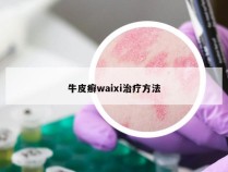 牛皮癣waixi治疗方法