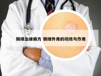 铜绿治顽癣方 铜绿外用的功效与作用