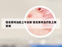 他克莫司治脸上牛皮癣 他克莫司治疗脸上银屑病