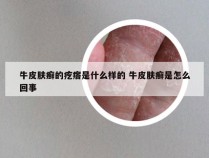 牛皮肤癣的疙瘩是什么样的 牛皮肤癣是怎么回事