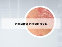 白癜风拔牙 白斑可以拔牙吗