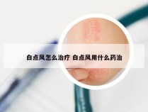 白点风怎么治疗 白点风用什么药治