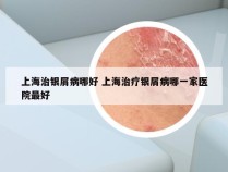 上海治银屑病哪好 上海治疗银屑病哪一家医院最好