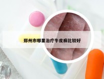 郑州市哪里治疗牛皮癣比较好