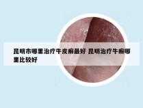 昆明市哪里治疗牛皮癣最好 昆明治疗牛癣哪里比较好