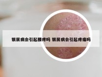 银屑病会引起腰疼吗 银屑病会引起疼痛吗