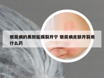 银屑病的黑斑能摸裂开宁 银屑病皮肤开裂用什么药