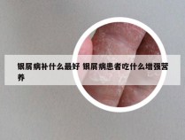 银屑病补什么最好 银屑病患者吃什么增强营养