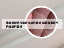 成都那所医院治疗皮肤科最好 成都哪家医院的皮肤科最好