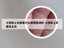 小孩身上长癣是什么原因造成的 小孩身上长癣怎么办