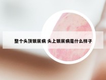 整个头顶银屑病 头上银屑病是什么样子