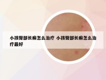 小孩臀部长癣怎么治疗 小孩臀部长癣怎么治疗最好