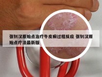 张钊汉原始点治疗牛皮癣过程反应 张钊汉原始点疗法最新版