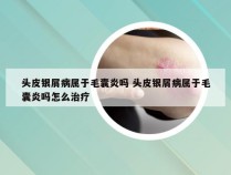 头皮银屑病属于毛囊炎吗 头皮银屑病属于毛囊炎吗怎么治疗