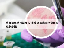 重度银屑病可活多久 重度银屑病治疗费用大概多少钱