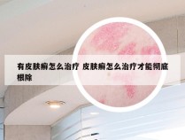 有皮肤癣怎么治疗 皮肤癣怎么治疗才能彻底根除