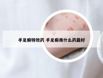 手足癣特效药 手足癣用什么药最好