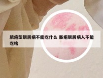 脓疱型银屑病不能吃什么 脓疱银屑病人不能吃啥