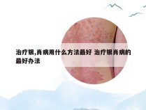 治疗银,肖病用什么方法最好 治疗银肖病的最好办法