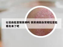 化验血能查银屑病吗 银屑病做血常规检查能看出来了吧