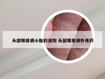 头部银屑病小瓶的滴剂 头部银屑病外用药