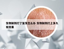 生物制剂打了复发怎么办 生物制剂打上多久有效果