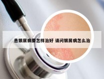 患银屑病要怎样治好 请问银屑病怎么治