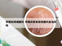 早期白斑病图片 早期白斑有症状图片能治好吗