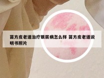 苗方皮老道治疗银屑病怎么样 苗方皮老道说明书照片