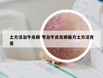 土方法治牛皮癣 专治牛皮皮癣偏方土方法克星