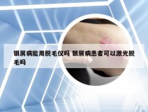 银屑病能用脱毛仪吗 银屑病患者可以激光脱毛吗