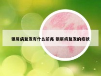 银屑病复发有什么前兆 银屑病复发的症状