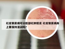 红皮银屑病可以脸部红肿脱皮 红皮银屑病身上要保持湿润吗?