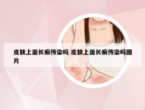 皮肤上面长癣传染吗 皮肤上面长癣传染吗图片