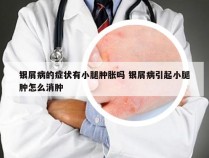 银屑病的症状有小腿肿胀吗 银屑病引起小腿肿怎么消肿