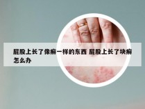 屁股上长了像癣一样的东西 屁股上长了块癣怎么办