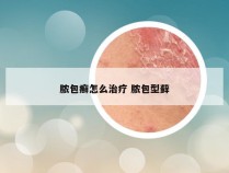 脓包癣怎么治疗 脓包型藓