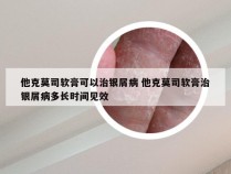 他克莫司软膏可以治银屑病 他克莫司软膏治银屑病多长时间见效