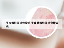 牛皮癣性生活传染吗 牛皮肤癣性生活会传染吗