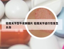 轻度关节型牛皮鲜图片 轻度关节退行性变怎么治