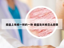 膝盖上有癣一样的一块 膝盖处长癣怎么回事